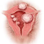 Fibroid, MDCAN offers free fibroid