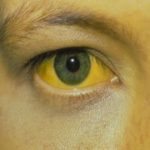 yellow fever, enugu, health ministryvaccination