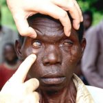 Blindness from diseased cornea, blind, people are blind