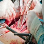 kidney transplant