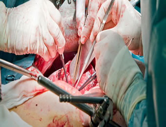 kidney transplant