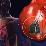 World Heart Day Africa,heart attack