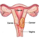 cervical cancer