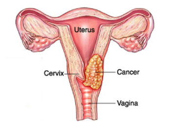 cervical cancer