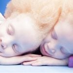 albino skin cancer albinism