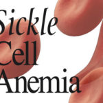 prevent sickle cell disease crises, Sickle cell survivor, sickle cell, African Sickle Cell Congress