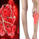 Unrecognised blood clots