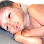 measles, UNICEF, WHO,