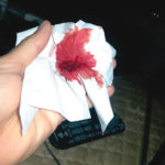 Blood in my stool