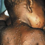 Quelling the spread of monkeypox, WHO records over 550 monkeypox