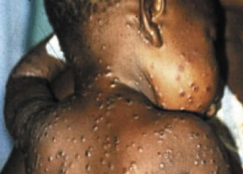 Quelling the spread of monkeypox, WHO records over 550 monkeypox