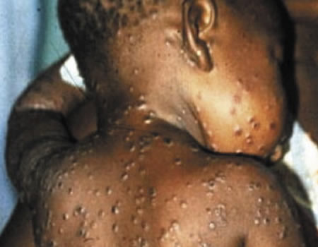 Children at high risk for monkeypox complications —Study