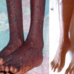 monkey-pox
