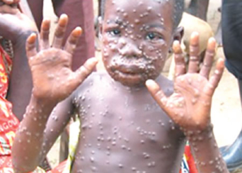 monkeypox monkey pox 2