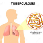 Is this tuberculosis?