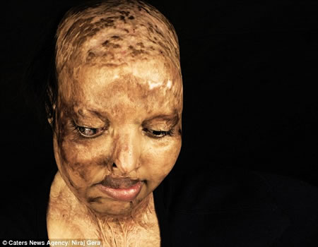 acid attack face2