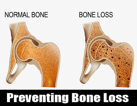 bone loss
