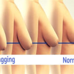 implant breast sagging