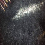 dandruff