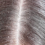Dandruff