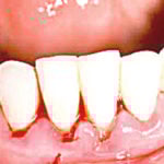 dentition Bleeding