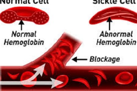 Initiative takes fight against sickle cell disease to