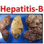 Hepatitis