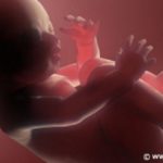 miscarriage