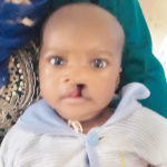 cleft, Organisation funds 30000 cleft lip