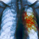 Misconception regarding covid , prompt Tuberculosis notification, Nigeria's 2030 Tuberculosis, Tuberculosis detection in blood samples, tuberculosis, TB, tuberculosis cases, COVID-19,