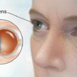 Cataract