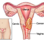 cancer