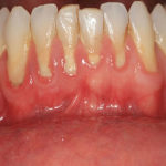 gum disease