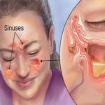 chronic sinus infection