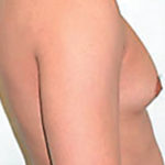 breast