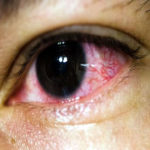 red eyes