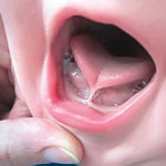 tongue tie