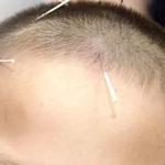 acupuncture
