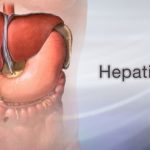 viral hepatitis