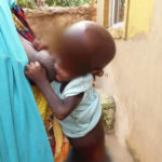 acute malnutrition, nutrition, malnutrition
