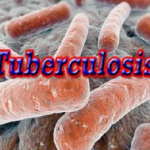 tuberculosis USAID Breakthrough Action Nigeria builds capacity on malaria, TB, COVID-19, TB patients rights in Nigeria, TB