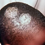 ringworm