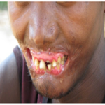 Extreme poverty, NOMA, stigmatize children with NOMA