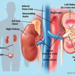 kidney disease?