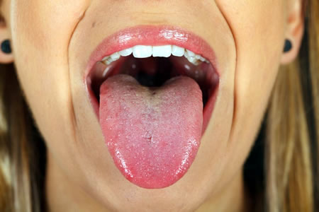 Sex oral tonsillitis from STDs and