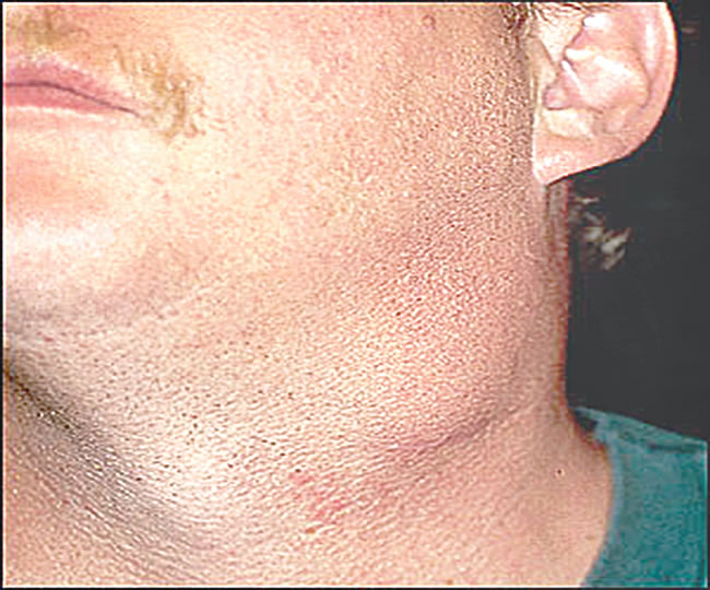 Can Lupus Cause Neck Lump