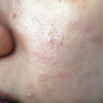 pimples