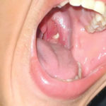 Can tonsils grow back after TONSILS
