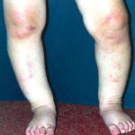 bow legs