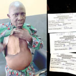 kidney transplant